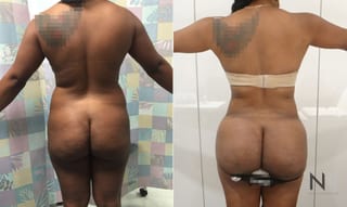 Before and after Brazilian Butt Lift six months results - Angle 1