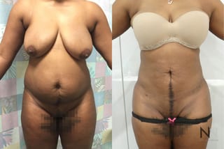 Before and after Brazilian Butt Lift six months results - Angle 2