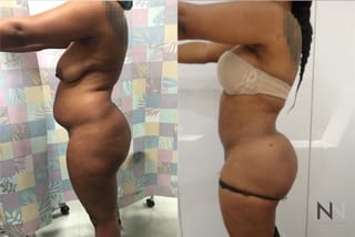 Before and after Brazilian Butt Lift six months results - Angle 3