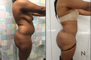 Before and after Brazilian Butt Lift six months results - Angle 4