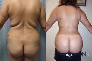 Liposuction of back and flanks with fat transfer to buttocks - Angle 1
