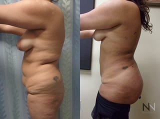 Liposuction of back and flanks with fat transfer to buttocks - Angle 2