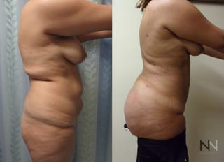 Liposuction of back and flanks with fat transfer to buttocks - Angle 3
