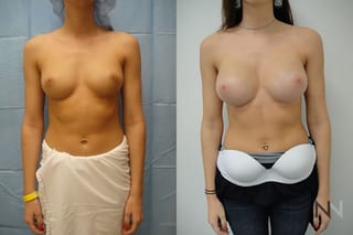 Before and after breast augmentation showing increased volume - Angle 1