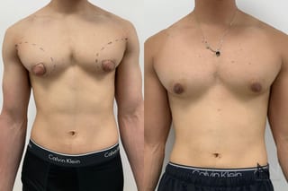 Before and after gynecomastia surgery four months results - Angle 1