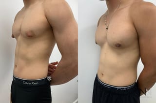 Before and after gynecomastia surgery four months results - Angle 4