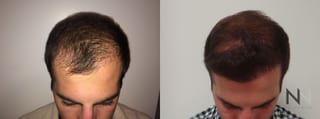 Before and after FUE hair transplant showing crown improvement - Angle 1