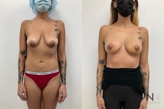 Before and after breast lift six months results - Angle 1
