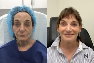 Neck lift results six months post-op with tighter skin - Angle 1