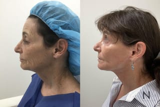 Neck lift results six months post-op with tighter skin - Angle 2