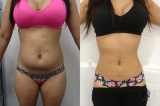 Awake liposuction showing improved waistline contour - Angle 1