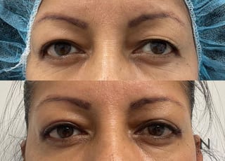 Upper blepharoplasty before and after eyelid contour improvement - Angle 1