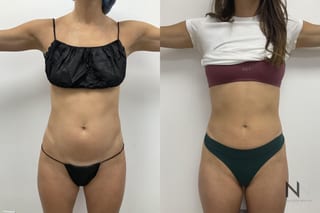 Liposuction of waist and abdomen showing improved contour - Angle 1