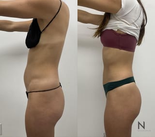 Liposuction of waist and abdomen showing improved contour - Angle 3