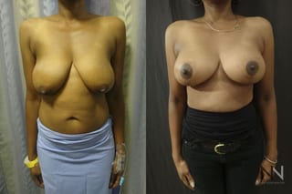 Breast contour improvement after mastopexy surgery - Angle 1
