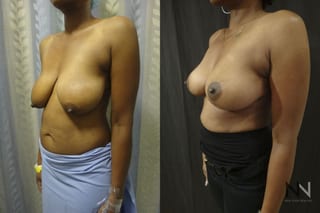 Breast contour improvement after mastopexy surgery - Angle 2