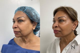 Neck lift before and after comparison frontal view - Angle 2