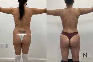Before and after BBL and liposuction six months results - Angle 1
