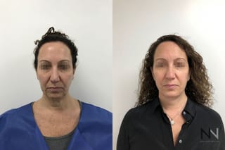 Mini facelift results six months post-op comparison - Angle 1