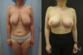 Breast lift results with improved support and contour - Angle 1
