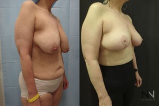 Breast lift results with improved support and contour - Angle 2