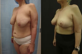 Breast lift results with improved support and contour - Angle 3