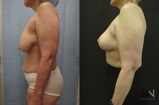 Breast lift results with improved support and contour - Angle 4