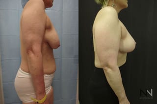 Breast lift results with improved support and contour - Angle 5