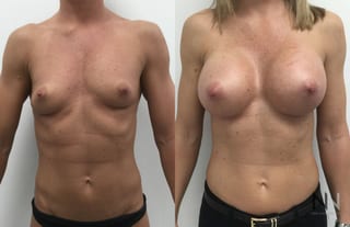 Breast implants showing increased volume and projection - Angle 1