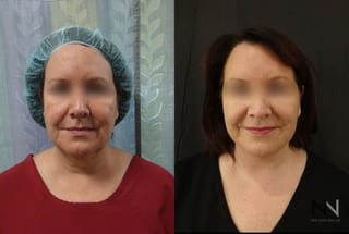 Neck lift showing improved jawline and neck contour - Angle 2