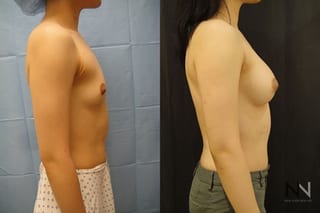 Breast augmentation results with improved projection - Angle 5