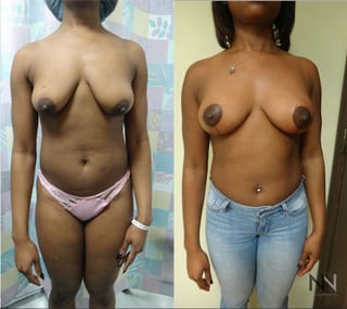 Before and after breast lift anchor technique six months - Angle 1