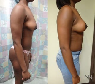 Before and after breast lift anchor technique six months - Angle 2
