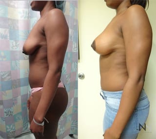 Before and after breast lift anchor technique six months - Angle 3