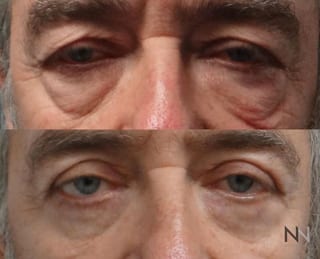 Before and after upper and lower blepharoplasty three months results - Angle 3