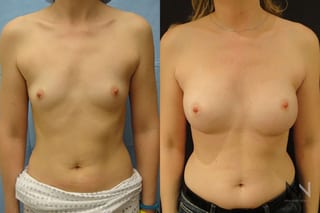 Breast augmentation before and after symmetry improvement - Angle 1