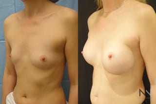 Breast augmentation before and after symmetry improvement - Angle 2