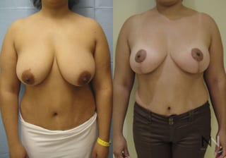 Before and after breast lift six months results - Angle 1
