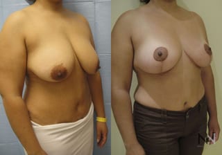 Before and after breast lift six months results - Angle 2