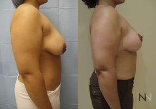 Before and after breast lift six months results - Angle 4