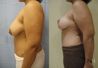 Before and after breast lift six months results - Angle 5