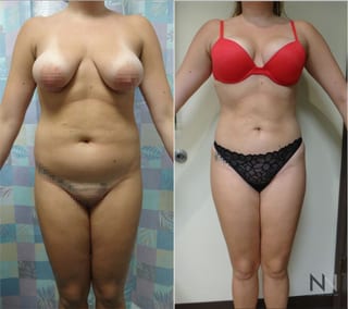 Before and after Brazilian Butt Lift six months results - Angle 2