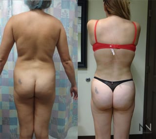 Before and after Brazilian Butt Lift six months results - Angle 1