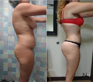Before and after Brazilian Butt Lift six months results - Angle 3