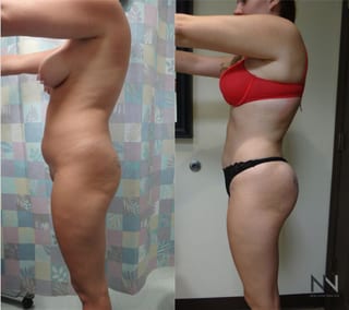 Before and after Brazilian Butt Lift six months results - Angle 4