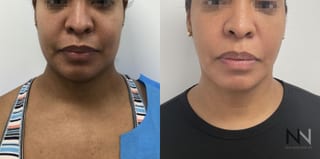 Submental liposuction showing improved jawline contour - Angle 3