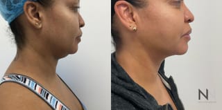 Submental liposuction showing improved jawline contour - Angle 1