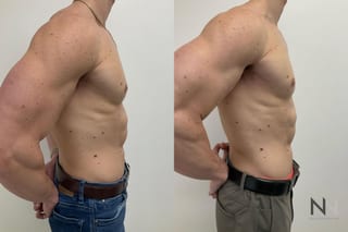 Gynecomastia before and after frontal view comparison - Angle 3