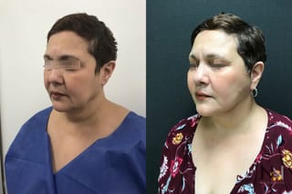 Before and after mini facelift and neck lift six months results - Angle 2