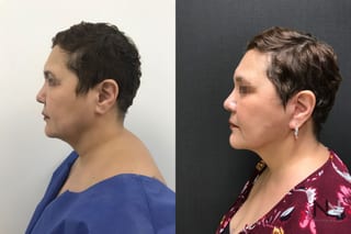 Before and after mini facelift and neck lift six months results - Angle 1